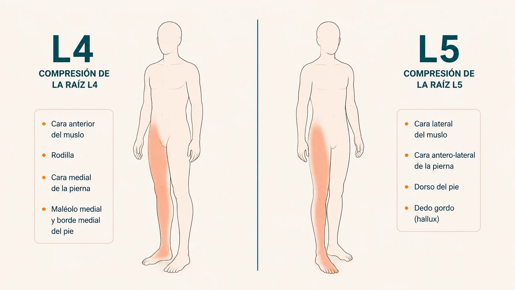 Dos siluetas humanas comparando la distribución del dolor según la raíz nerviosa comprimida (L4 vs L5) en una hernia L4-L5