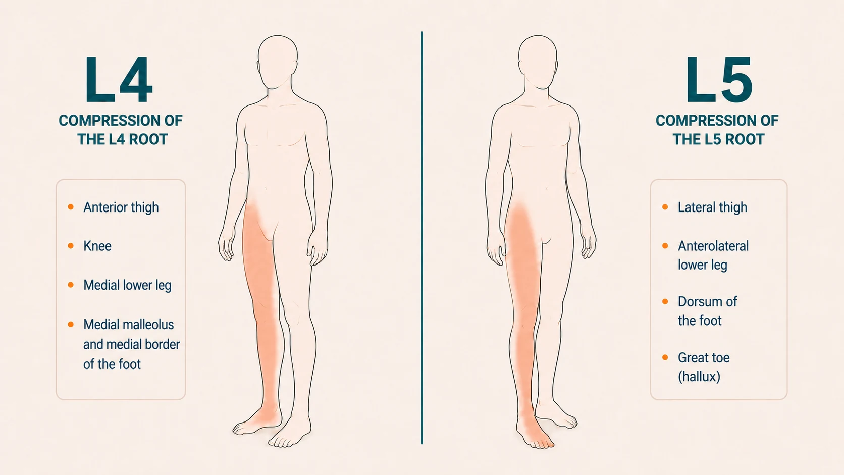Two human silhouettes comparing pain distribution by compressed nerve root (L4 vs L5) in an L4-L5 herniation