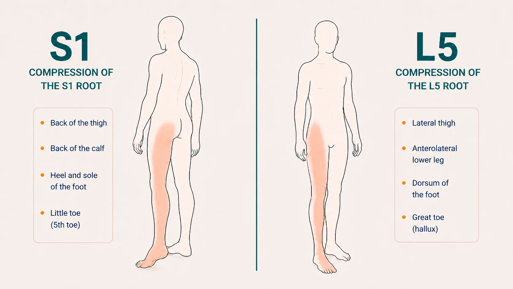 Two human silhouettes comparing pain distribution by compressed nerve root (S1 vs L5) in an L5-S1 herniation